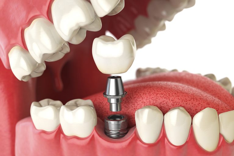 Dental Implants Warner Dental Care
